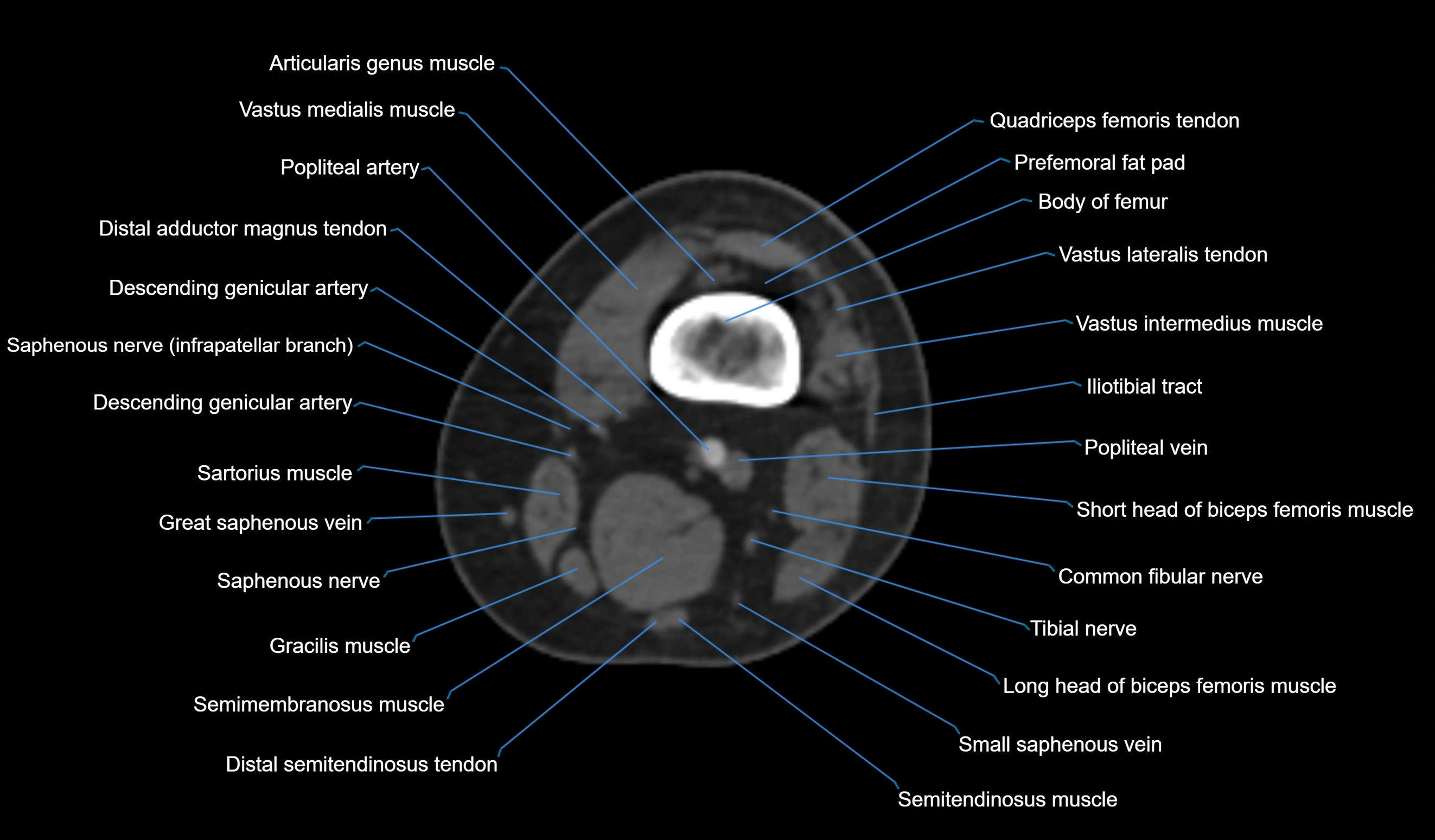 CT knee axial cross sectional anatomy labelled image-00012.webp